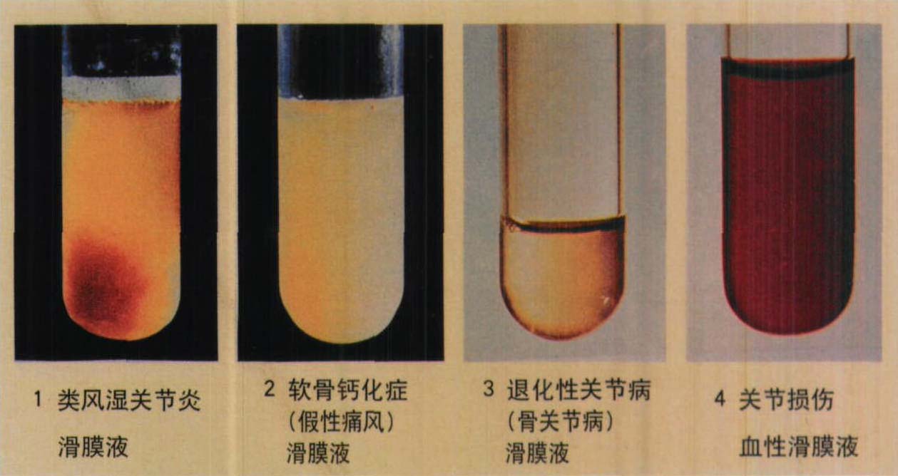 30.各種病人的關(guān)節(jié)液